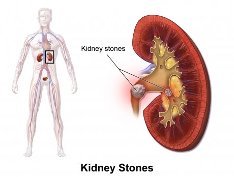 kidney stone 003