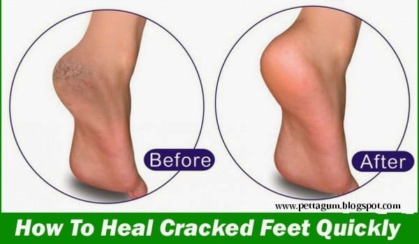How To Heal Cracked Feet Quickly