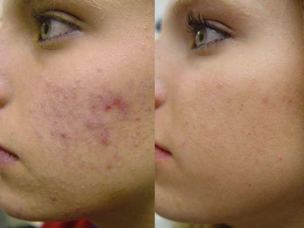 pimple scars 03 1486101567
