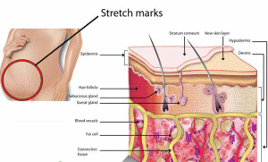 What Causes Stretch Marks 1