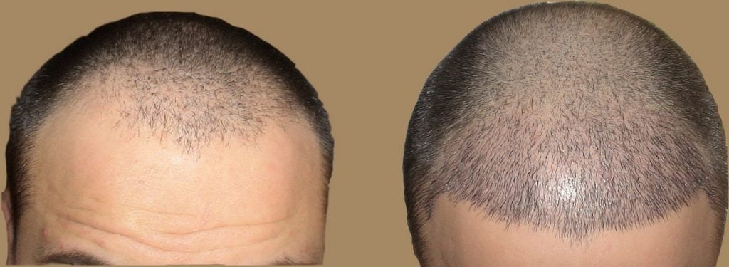 patient 4 before and after fue 2700 grafts 10 days 8wxp
