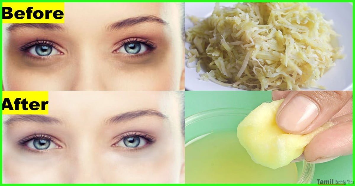 Best Home Remedies To Remove Dark Circles Under Eyes Permanently
