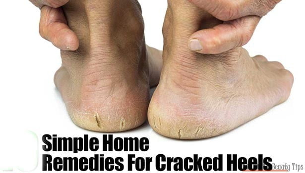 cracked heel natural remedy1. L