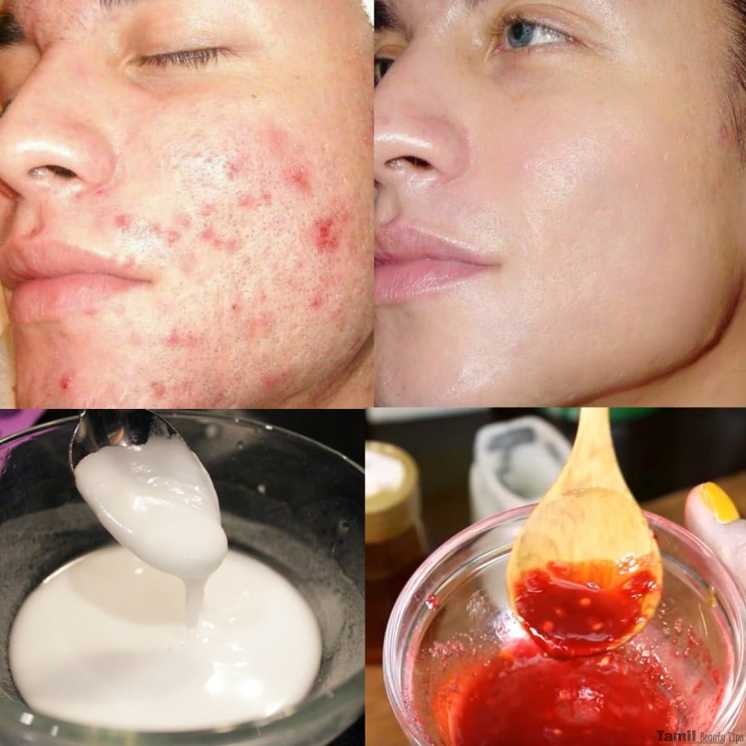 acne and pimples