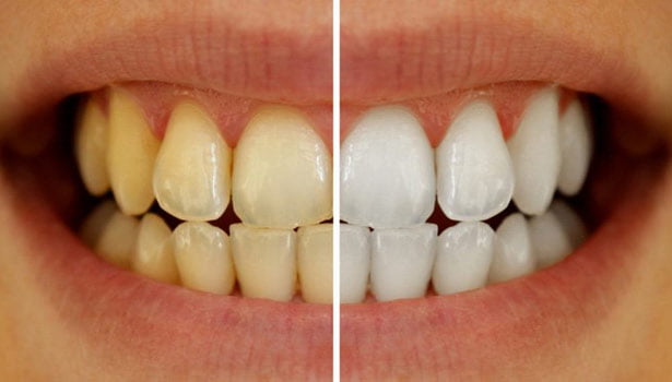 yellow stains on teeth natural way SECVPF