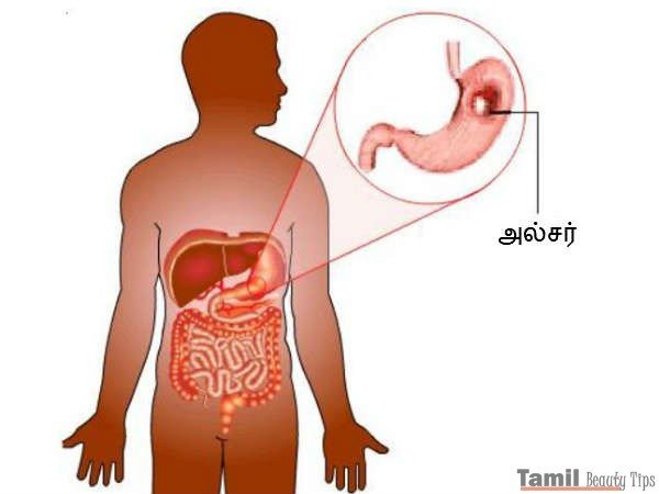 ulcer stomach