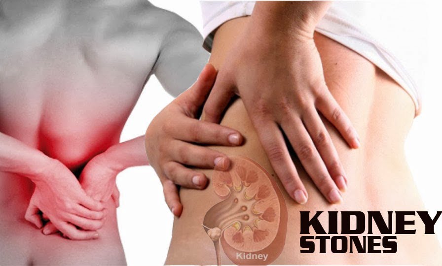 kidney stones remedy