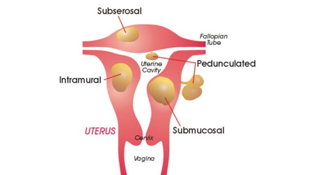 uterus 685