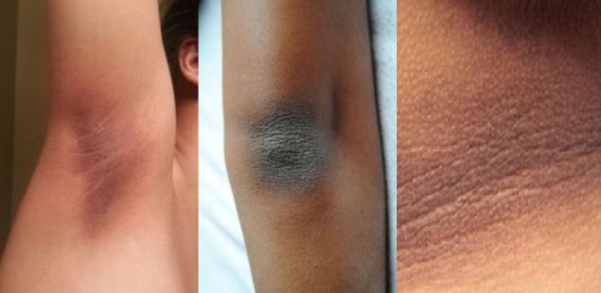 Complete Guide For Removing Dry and Dark Skin on Your Neck Elbows Knees and Underarms