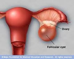 Ovary Cyst
