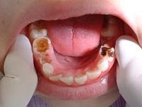 pediatric cavities1