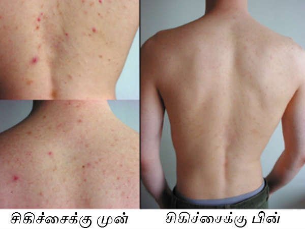 back acne 15 1455530793