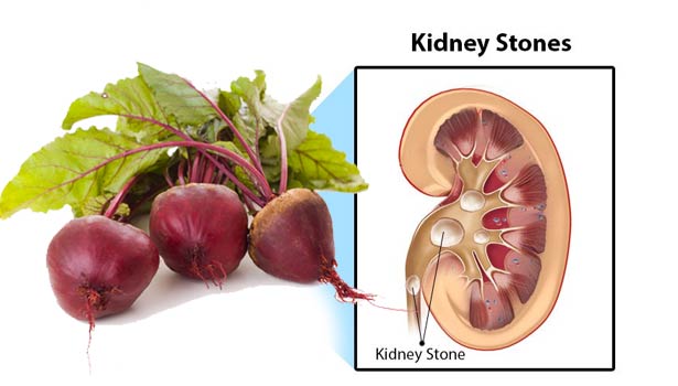 201608010936172724 Preventing beetroot formation kidney stones SECVPF