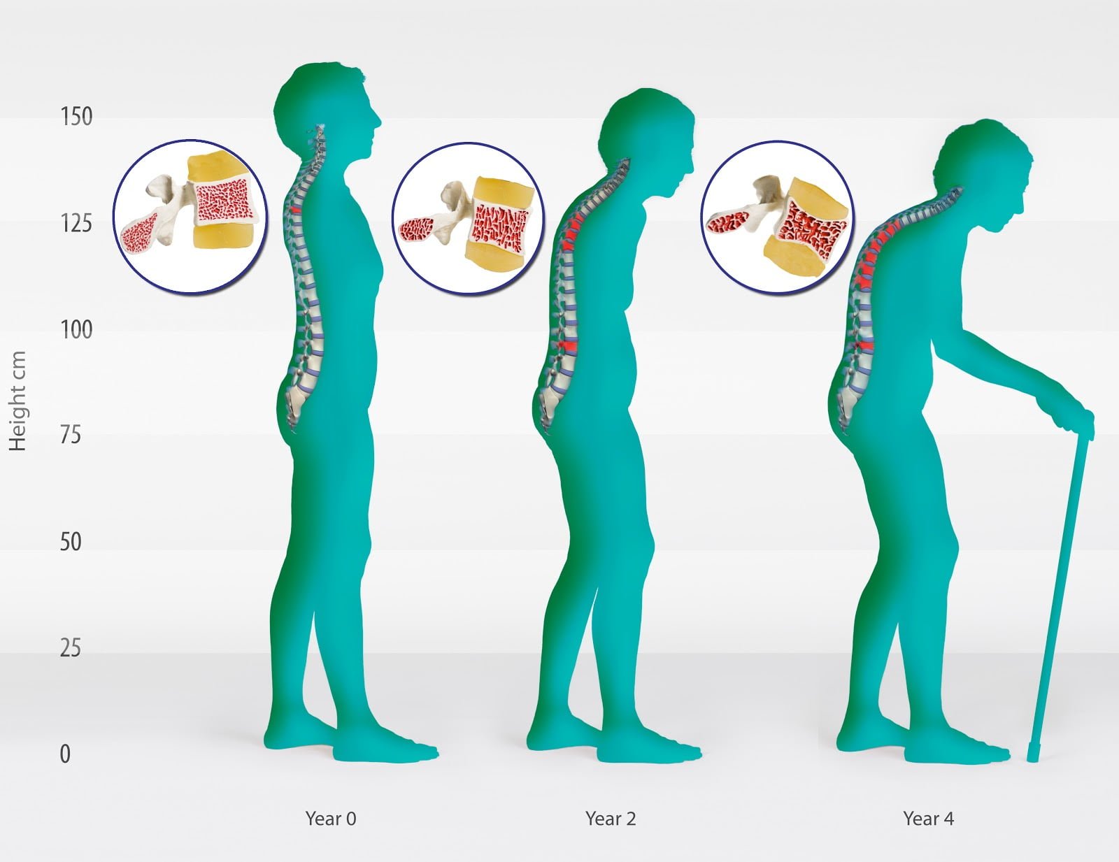 Osteoporosis Stages1