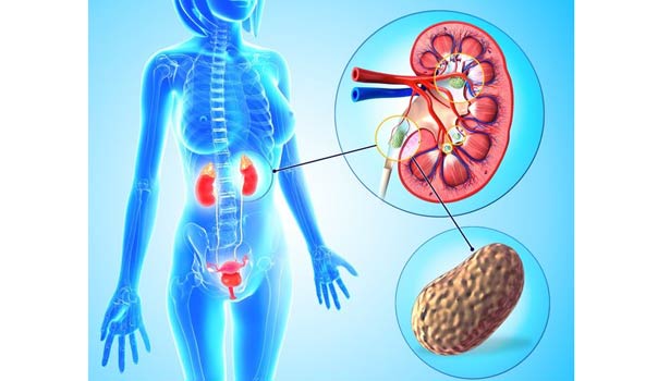 201609100954266938 How to prevent kidney stones SECVPF