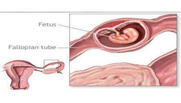 201612071442270230 Ectopic Pregnancy fetus tube pregnancy How to identify SECVPF