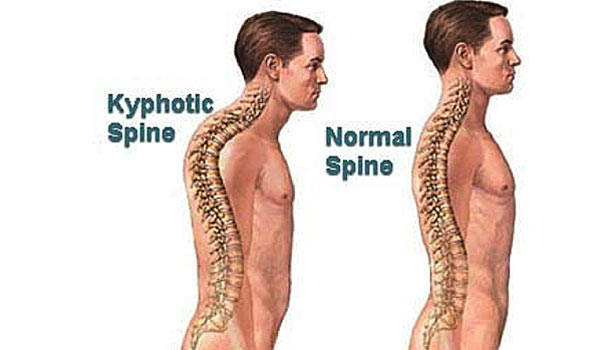 201701311014127028 What is the cause of aging kyphotic spine SECVPF
