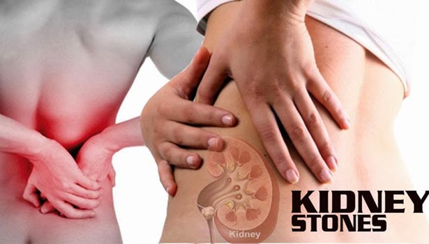 201703011411516387 Surgery for kidney stones SECVPF