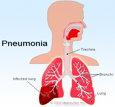 pneumonia1