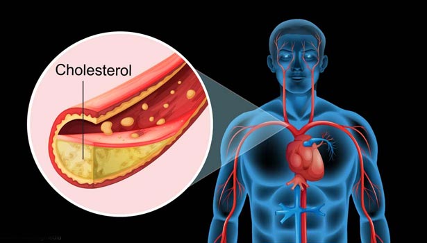 201704151105114393 May I know a few things about cholesterol SECVPF