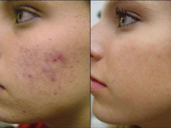 pimple free skin 03 1480755239