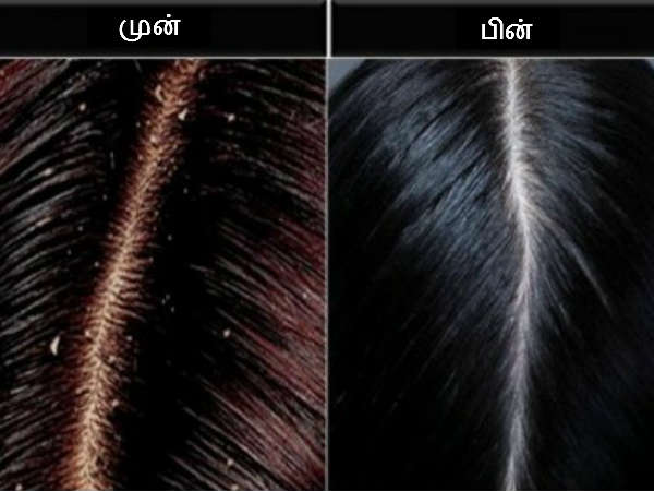 22 1482388175 8 dandruff before after