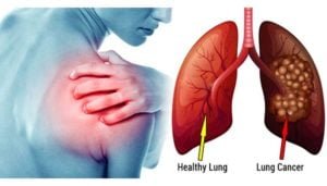 201703211225461034 Symptoms that suggest lung cancer in women SECVPF