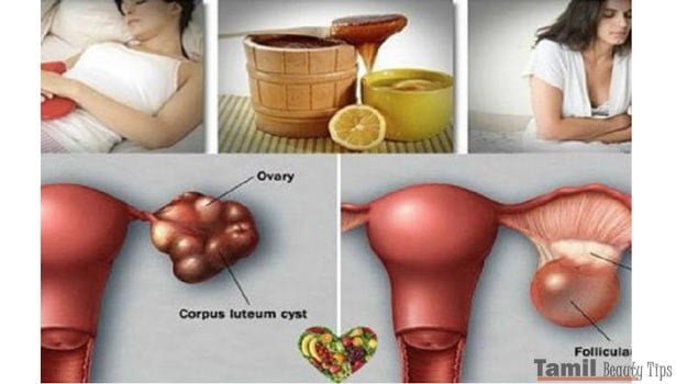 Uterine cysts that are barred from pregnancy