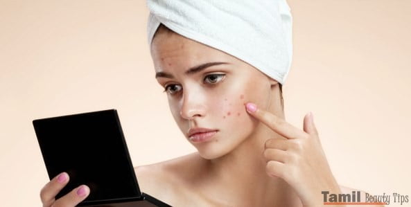 rupcare How To Get Rid Of Pimples