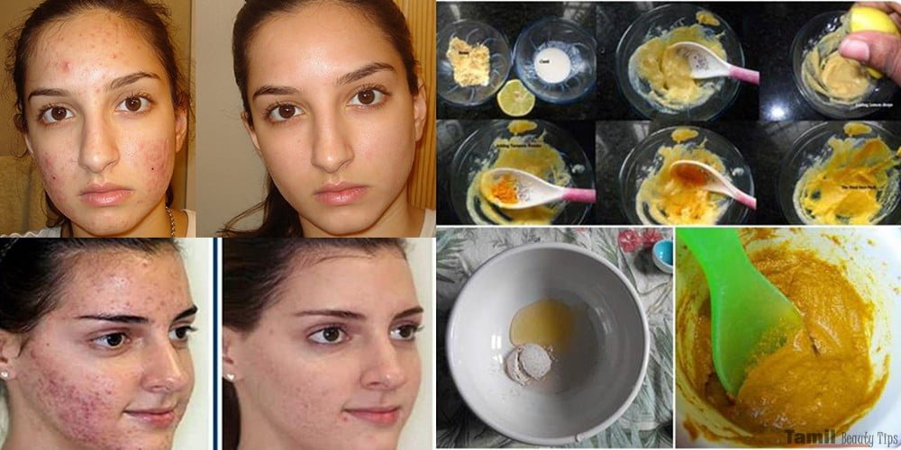 Best Home Remedy To Get Rid Of Pimples Fast