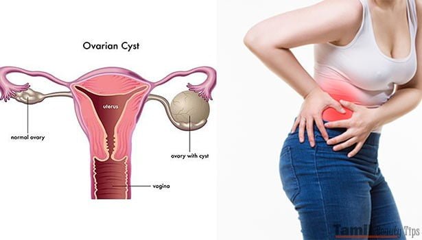 symptoms of ovarian tumor