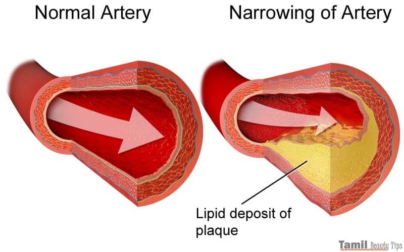 Cholesterol plaque