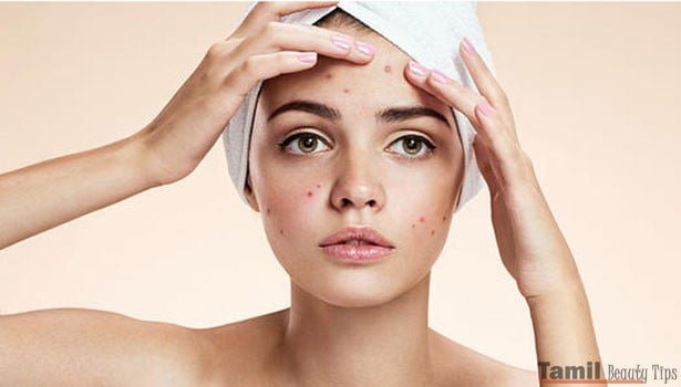 Natural way to control pimples SECVPF