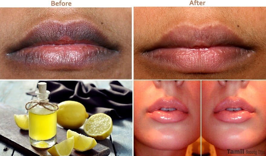 Make Your Dark Lips Fare Now Home Remedy