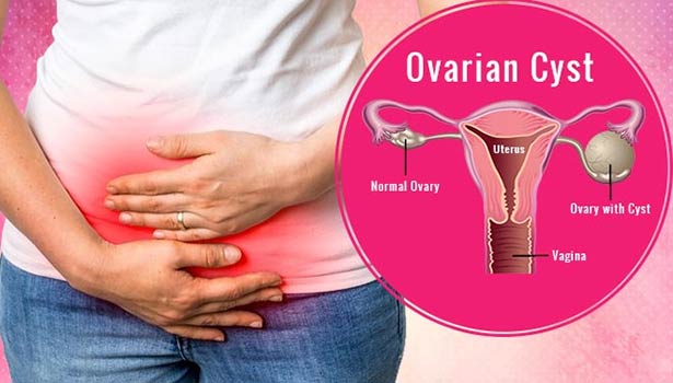 women affecting uterus Cysts