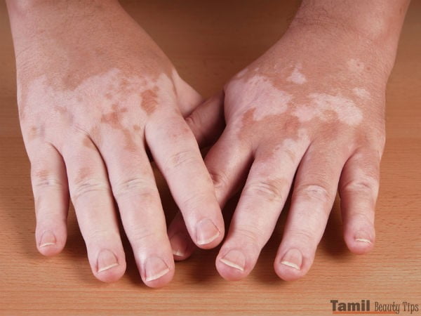 vitiligo 1