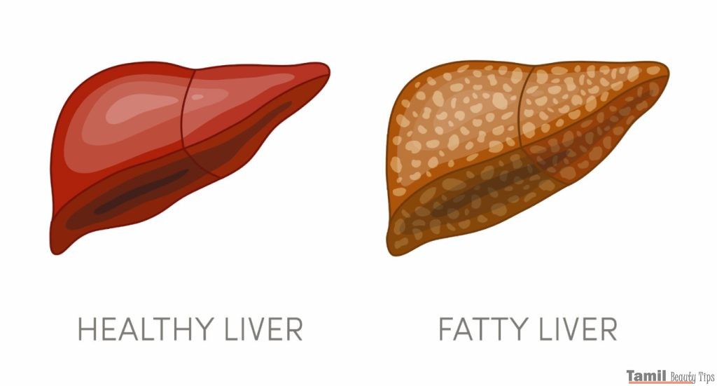 fatty liver meaning in tamil