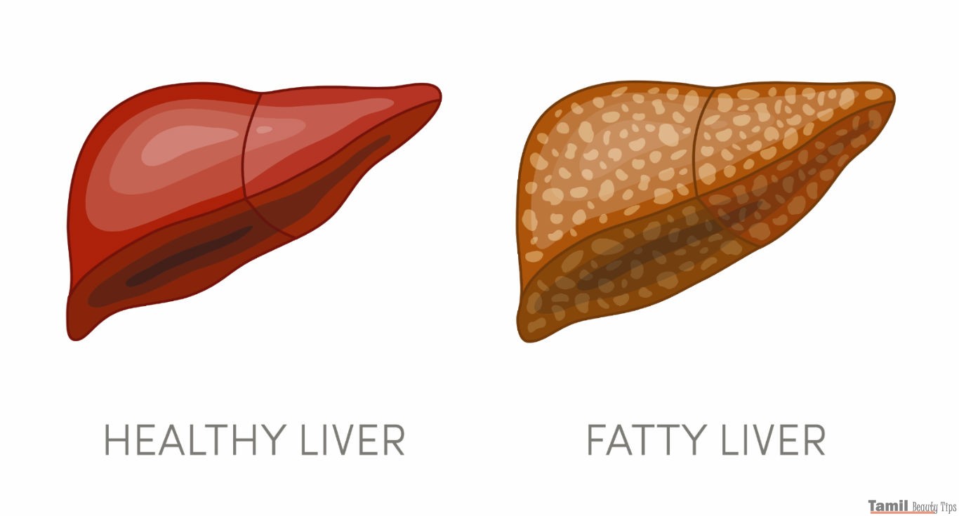 fatty liver meaning in tamil