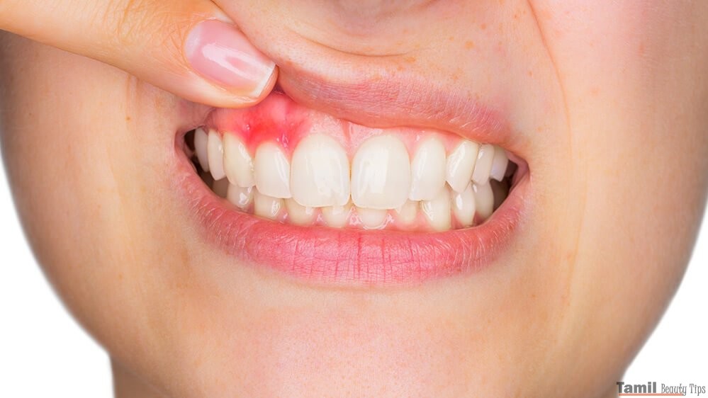 Swelling of the Gums
