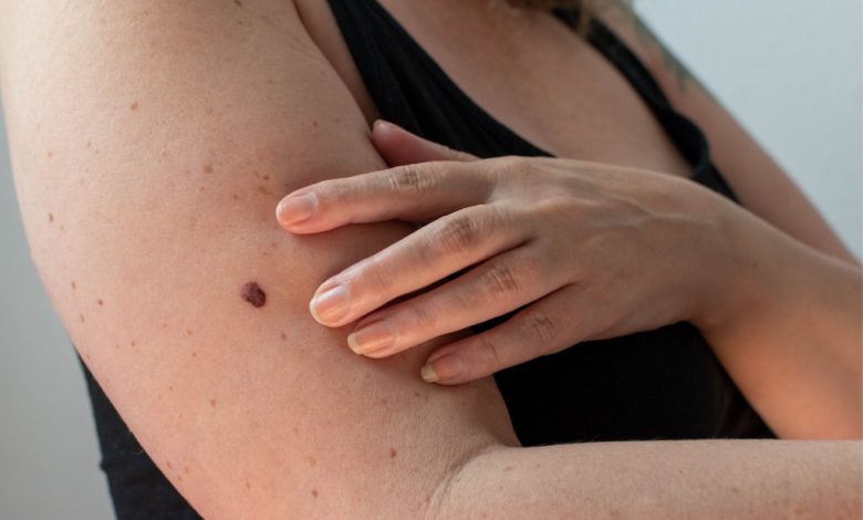 a guide to skin cancer symptoms prevention and treatments